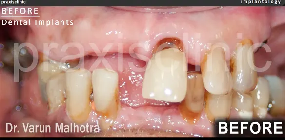 Multiple missing teeth in both the upper and lower jaw of a patient. Full Mouth Rehabilitation planned to replaced with a multiple dental implants at Praxis Dental Clinic, Mumbai, India by Dr Varun Malhotra, Top Dental 
                            Implant surgeon of Mumbai, India 